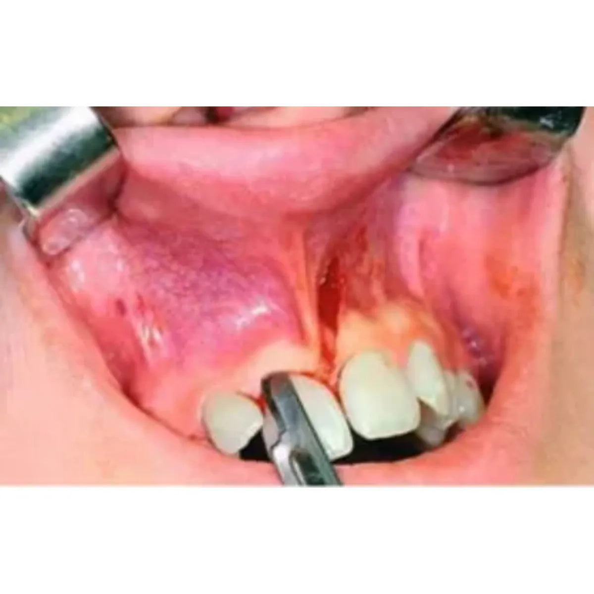 rmc surgical blade no. 11 . 100pce