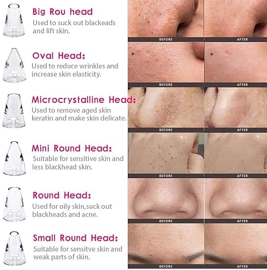 multi functional cleaning massager Blackhead Removal With Pimples & Pore Cleaner Upgraded Chargeable Vacuum Device/With 6 Changeable Functional Heads With 3 Levels Adjustable Mode